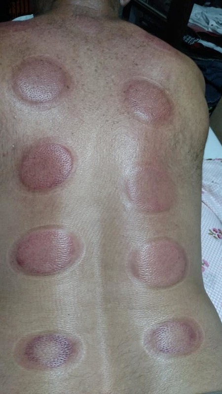 resultado da ventosaterapia outros massoterapeuta aromaterapeuta quiropraxista acupunturista outros