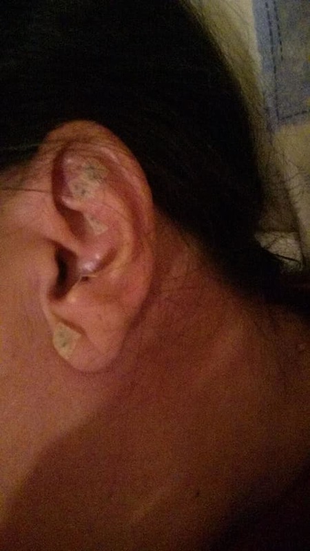 Auriculoterapia com sementes outros massoterapeuta aromaterapeuta quiropraxista acupunturista outros