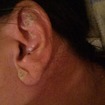 Auriculoterapia com sementes