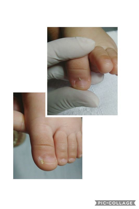 Podologia infantil 😍, unha encravada podólogo(a) depilador(a) designer de sobrancelhas micropigmentador(a)