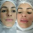 Atena e depois de micropigmentação de lábios