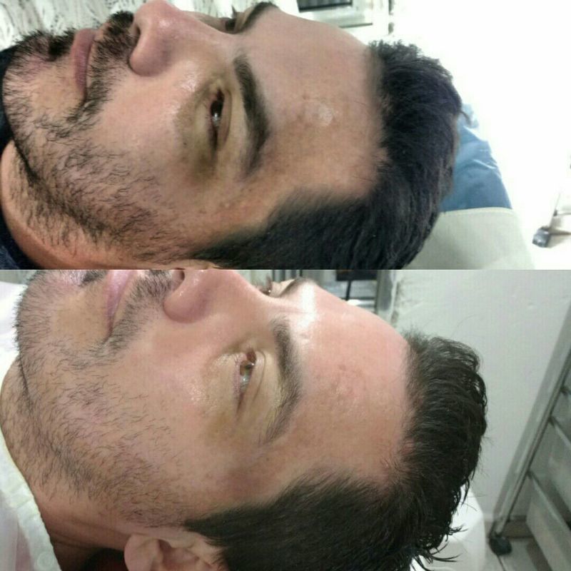 Clareamento facial em pele com manchas solares e melasmas+hidratação profunda esteticista designer de sobrancelhas dermopigmentador(a) massoterapeuta micropigmentador(a) podólogo(a) depilador(a)