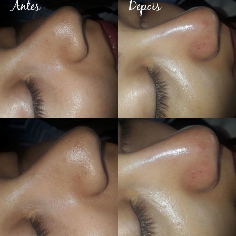 Limpeza de pele estética esteticista