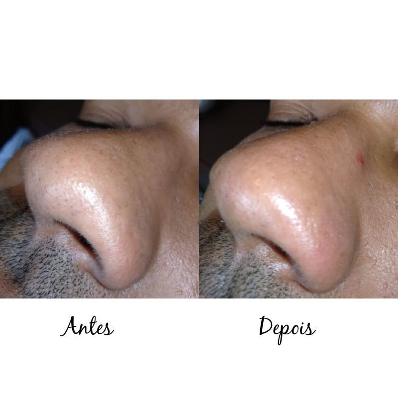 Limpeza de pele estética esteticista