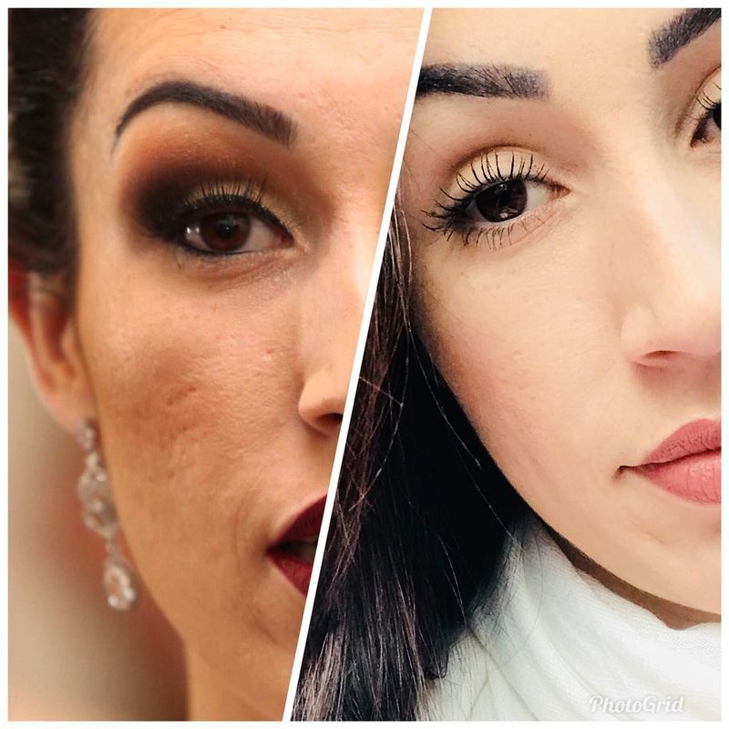 Microagulhamento estética esteticista