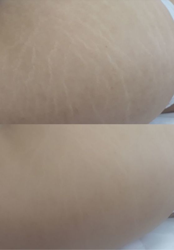 Micropuntura estrias antes e depois. estética micropigmentador(a) designer de sobrancelhas maquiador(a) depilador(a)