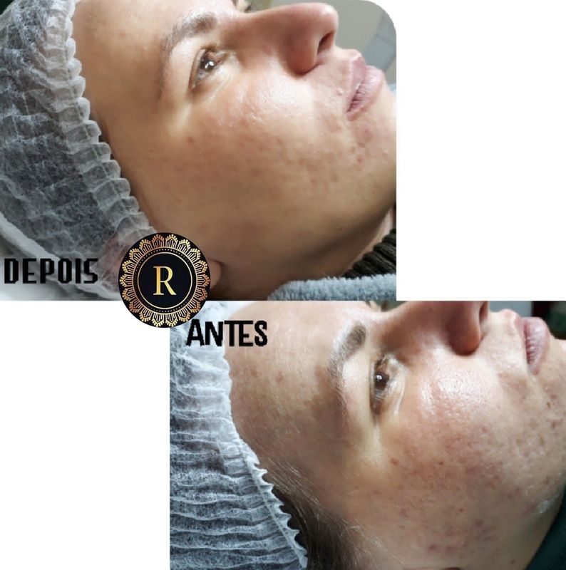 Microagulhamento facial antes e depois. estética micropigmentador(a) designer de sobrancelhas maquiador(a) depilador(a)