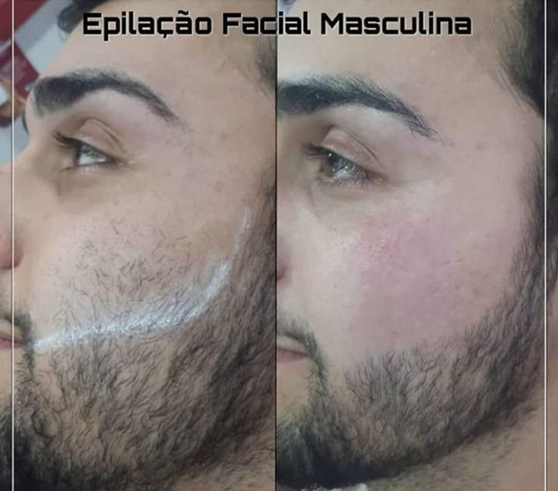 Foto Parte da barba retirada toda na linha o resultado CBeauty