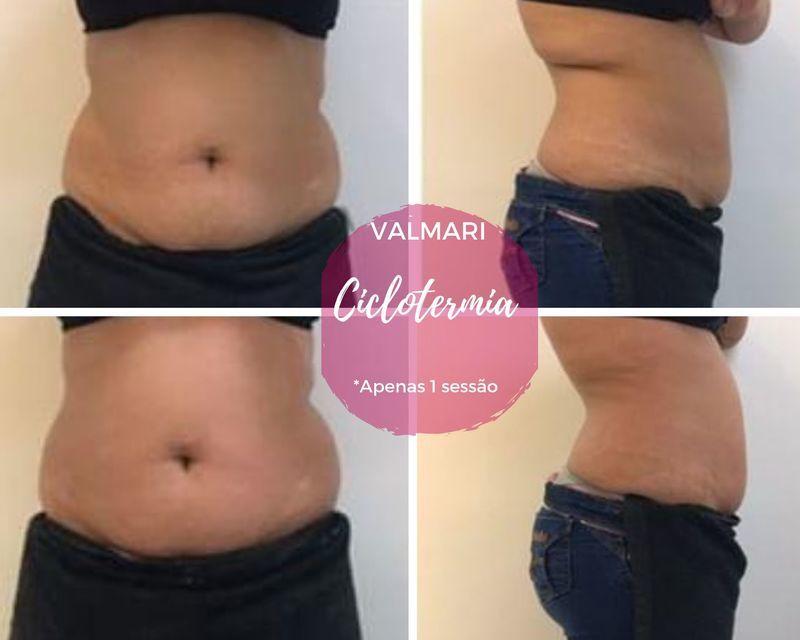 Massagem modeladora antes e depois estética esteticista manicure e pedicure designer de sobrancelhas