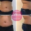 Massagem modeladora antes e depois