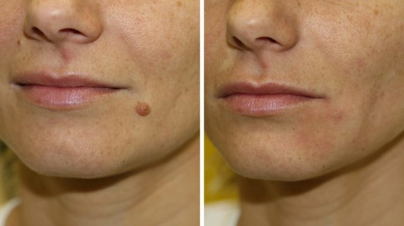 Retire aquela verruga q tanto te incomoda. 31 95404778. 30317473. estética depilador(a) esteticista
