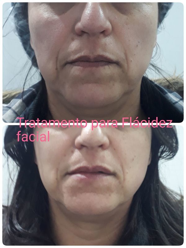 Tratamento  de Flácidez Facial
Victalab estética biomédico(a)