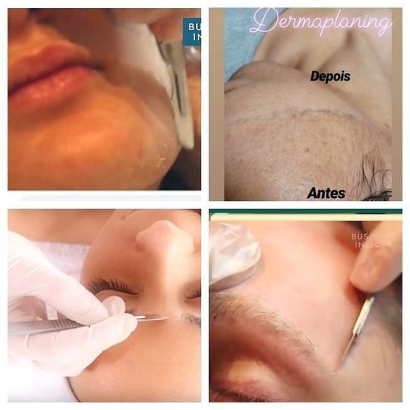 Dermaplaning
promove uma esfoliação profunda, removendo a camada mais superficial da pele, trás diversos benefícios para a beleza e saúde da pele deixando-a mais firme,lisa, uniforme e rejuvenescida
*Remove as células mortas da pele
*Estimula a produção de colágeno e elastina prevenindo a flacidez facial
*Auxilia na redução das rugas e marcas de expressão
*Desobstrui e fecha os poros
*Ajuda  no controle da oleosidade
*Melhora a absorção de dermocosmeticos da pele
*Deixa a pele renovada sem aspereza mais limpa e lisa
*Recupera a maciez e uniformidade da pele
*O procedimento pode ser feito em qualquer tipo e tonalidade de pele. estética micropigmentador(a)