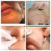 Dermaplaning
promove uma esfoliação profunda, removendo a camada mais superficial da pele, trás diversos benefícios para a beleza e saúde da pele deixando-a mais firme,lisa, uniforme e rejuvenescida
*Remove as células mortas da pele
*Estimula a produção de colágeno e elastina prevenindo a flacidez facial
*Auxilia na redução das rugas e marcas de expressão
*Desobstrui e fecha os poros
*Ajuda  no controle da oleosidade
*Melhora a absorção de dermocosmeticos da pele
*Deixa a pele renovada sem aspereza mais limpa e lisa
*Recupera a maciez e uniformidade da pele
*O procedimento pode ser feito em qualquer tipo e tonalidade de pele.