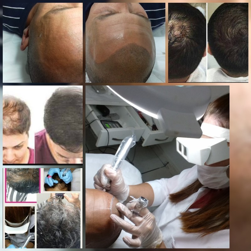 Tricopigmentaçao
Trata alopecia
Melhora a estética
Rejuvenesce
Camufla
Imita o folículo capilar estética micropigmentador(a)