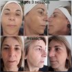 Rejuvenescimento dermaroller
Mais ativos permeáveis , ácidos , LED...