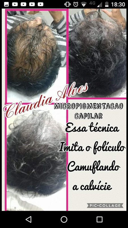 Micropigmentação capilar
Tricopigmentaçao estética micropigmentador(a)