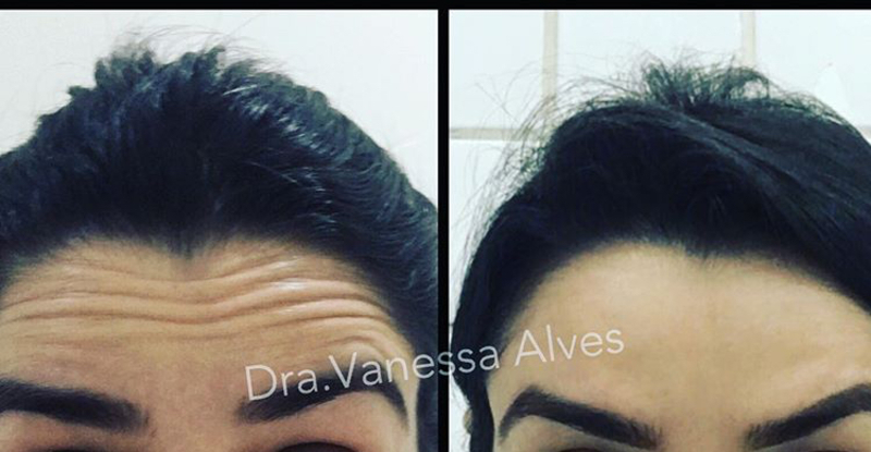 Toxina botulínica ação preventiva!!! estética biomédico(a)