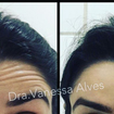 Toxina botulínica ação preventiva!!!