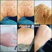 Tratamento com peeling químico 1 sessão
Resultado incrível!!!!
