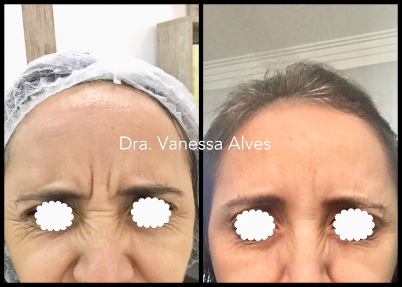 Botox estética biomédico(a)
