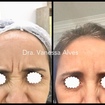 Botox