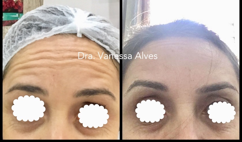 Botox estética biomédico(a)