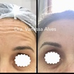 Botox