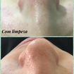antes e depois da extração na limpeza de pele. 
