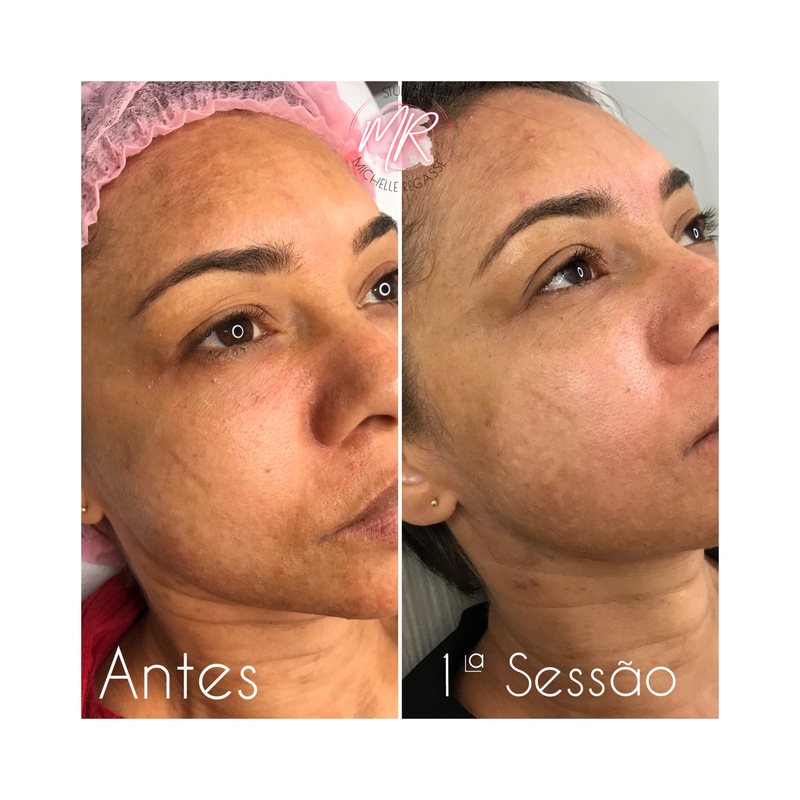 Protocolo de melasma 
#melasma  estética 