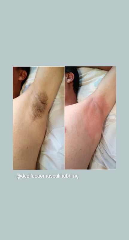 Axilas limpas estética depilador(a) esteticista