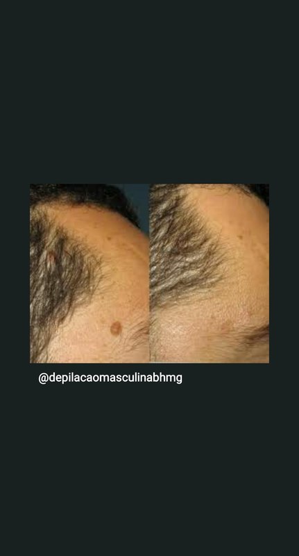 Remoçao verruga estética depilador(a) esteticista