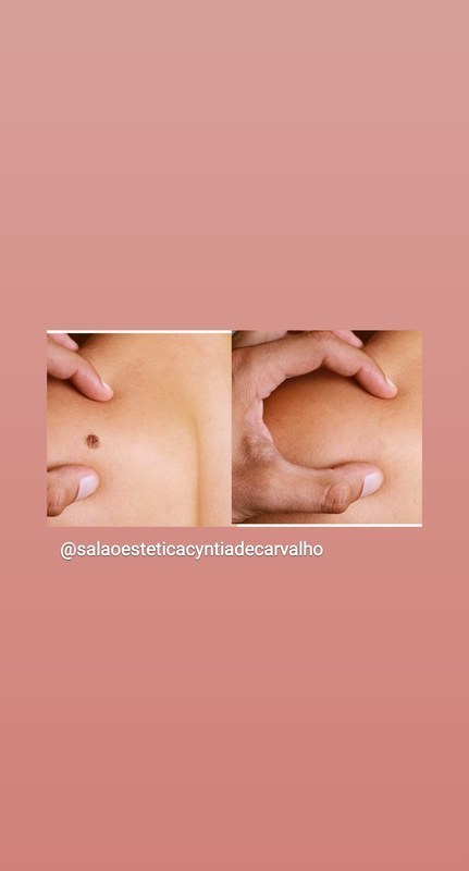 Remocao verruga estética depilador(a) esteticista