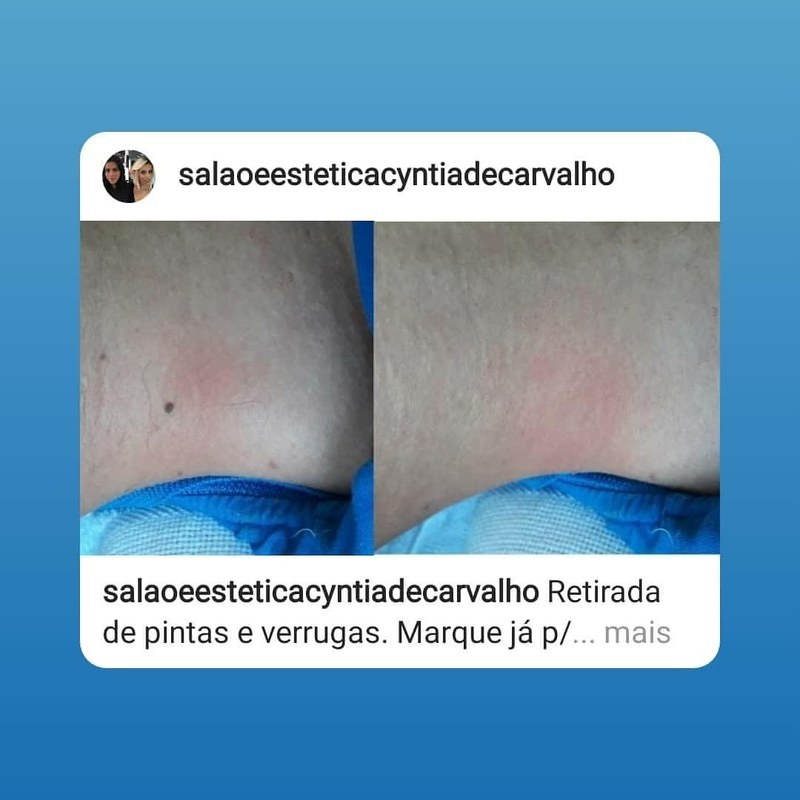 Retirada de pinta estética depilador(a) esteticista