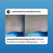 Retirada de pinta