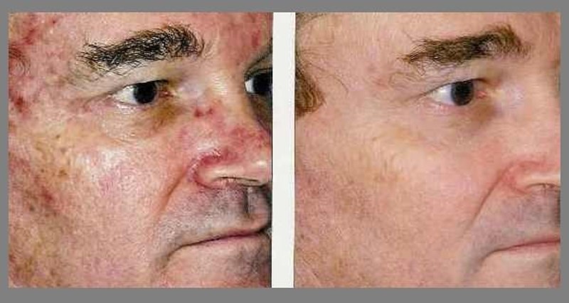 Clareamento  estética depilador(a) esteticista