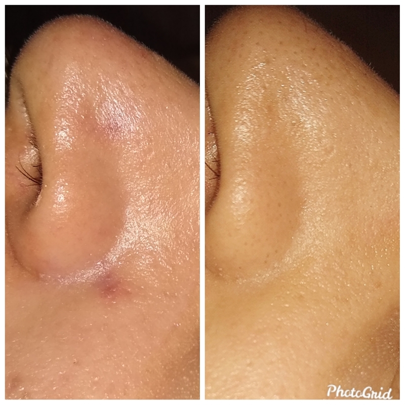 Limpeza de pele. estética esteticista maquiador(a) designer de sobrancelhas
