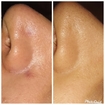 Limpeza de pele.