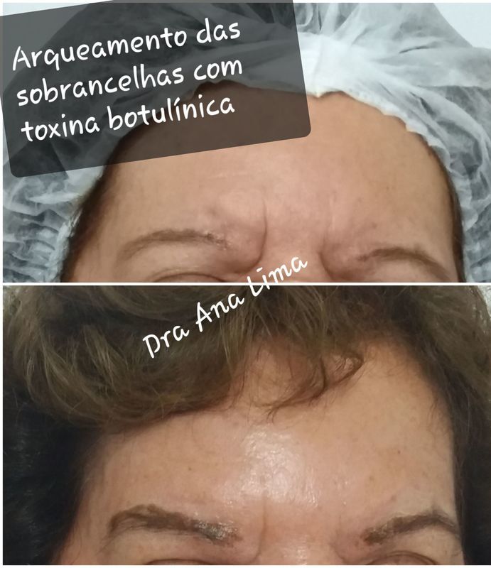 Arqueamento natural das sobrancelhas com toxina botulinica estética biomédico(a)