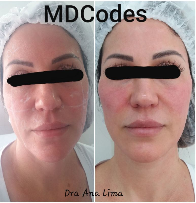 MDCodes com ácido hialuronico estética biomédico(a)