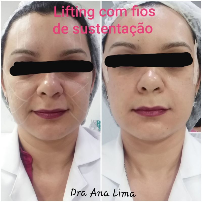 Lifting com fios de sustentação absorvíveis. Pós imediato. estética biomédico(a)