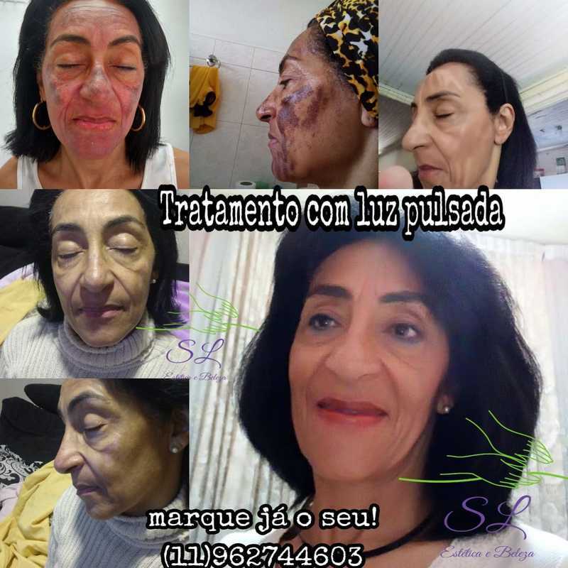 Tratamento de manchas feito com luz intensa pulsada ...top top

#manchas #tratamentofacial #luzpulsada #fimdasmanchas #estetica  estética esteticista