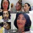 Tratamento de manchas feito com luz intensa pulsada ...top top

#manchas #tratamentofacial #luzpulsada #fimdasmanchas #estetica 