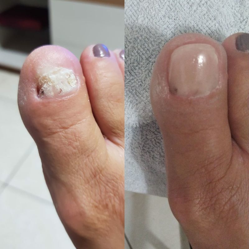 Reconstrução de unha manicure e pedicure