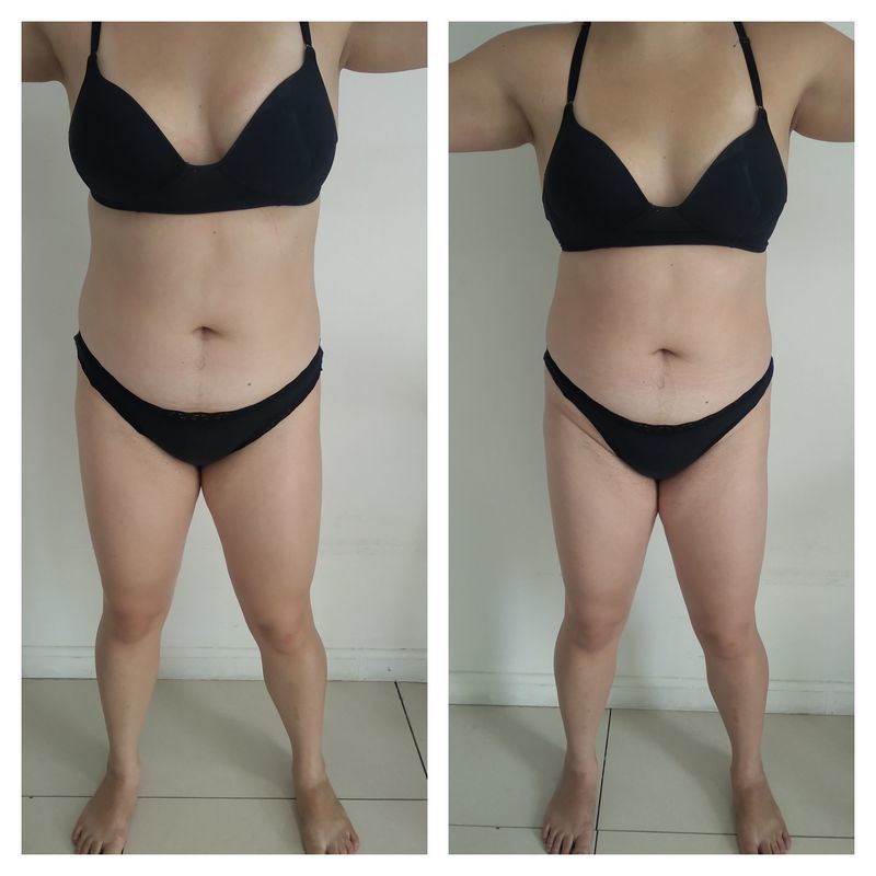 Drenagem linfática antes e depois, 1 sessão estética esteticista