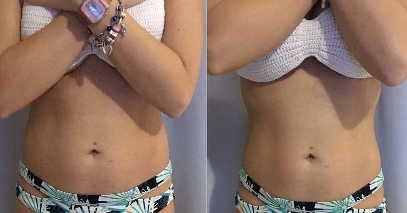 Drenagem linfática antes e depois 1 sessão estética esteticista