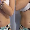 Drenagem linfática antes e depois 1 sessão