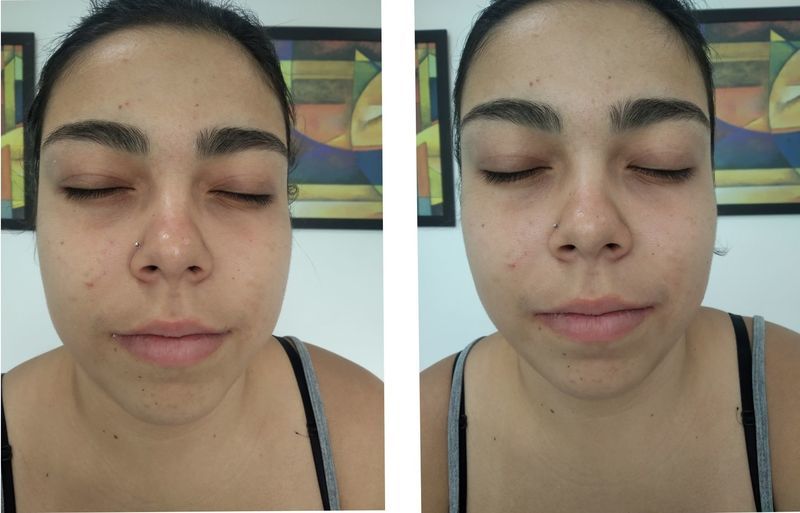 Antes e depois limpeza de pele estética esteticista