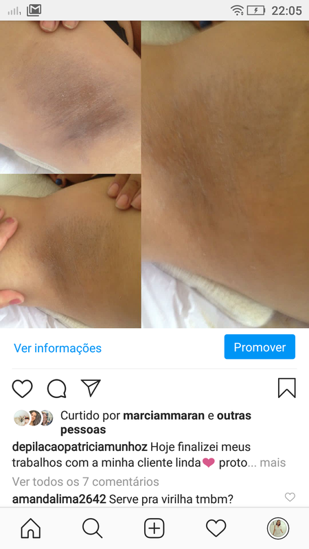 Sessão de argiloterapia (clareamento nas axilas) estética depilador(a)