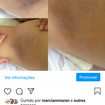 Sessão de argiloterapia (clareamento nas axilas)